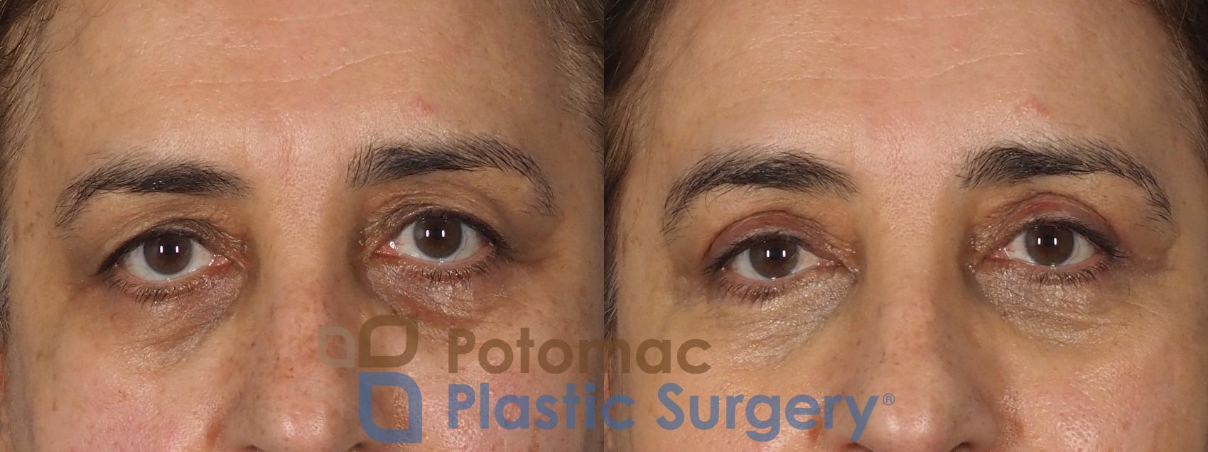 Before & After Blepharoplasty Case 278 Front View in Washington, DC