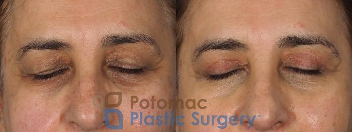 Before & After Blepharoplasty Case 278 Front - Eyes Closed View in Washington, DC