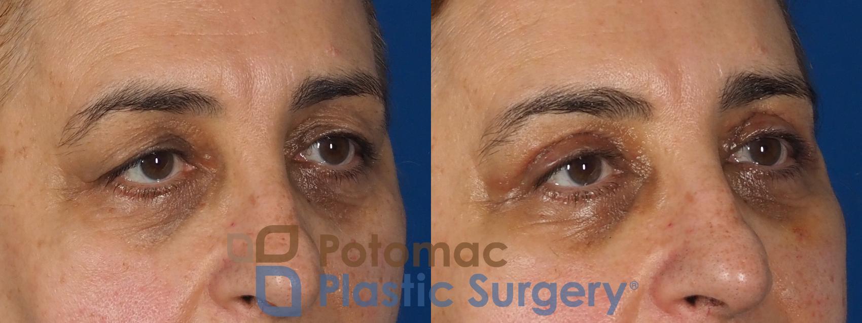 Before & After Blepharoplasty Case 278 Right Oblique View in Washington, DC