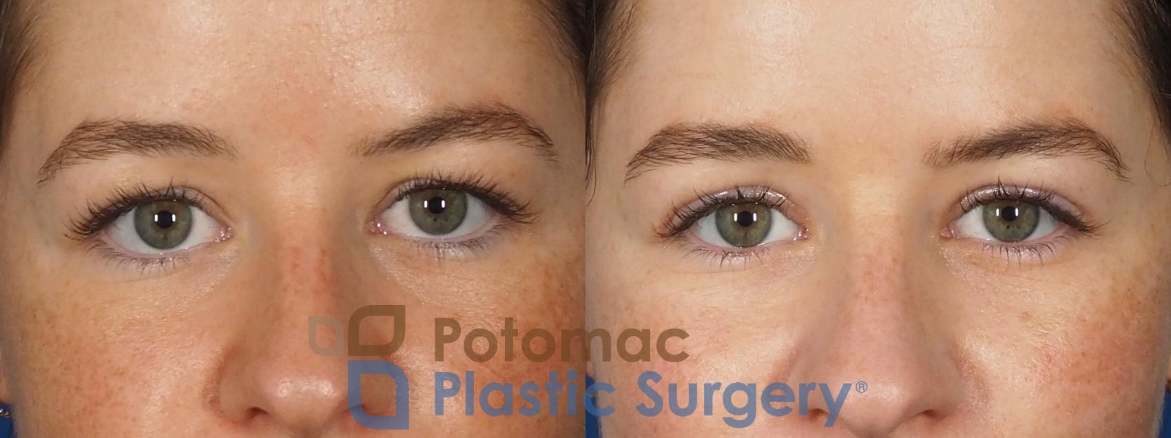 Before & After Blepharoplasty Case 305 Front View in Washington, DC