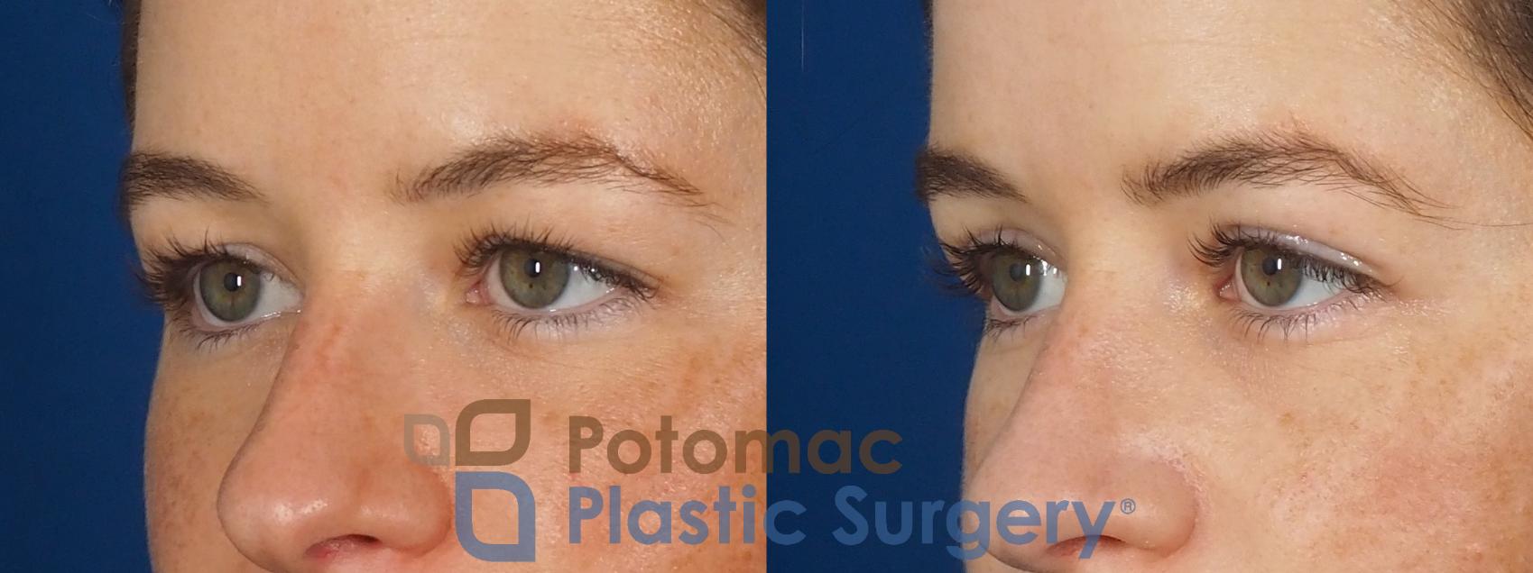 Before & After Blepharoplasty (Eyelid Surgery) Case 305 Left Oblique View in Washington DC & Arlington , DC