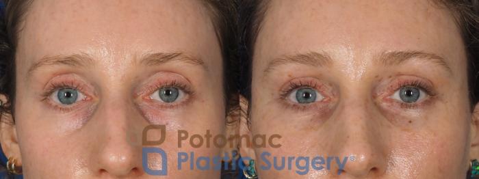 Before & After Blepharoplasty Case 316 Close up View in Washington, DC