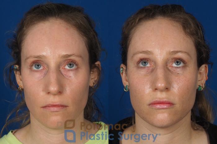 Before & After Blepharoplasty Case 316 Front 2 View in Washington, DC