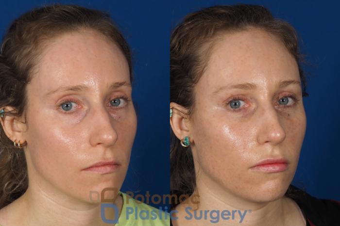 Before & After Blepharoplasty Case 316 Right Oblique 2 View in Washington, DC