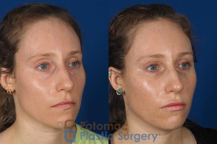 Before & After Blepharoplasty Case 316 Right Oblique View in Washington, DC