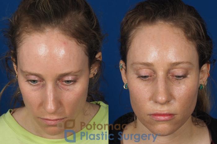 Before & After Blepharoplasty Case 316 Top View in Washington, DC
