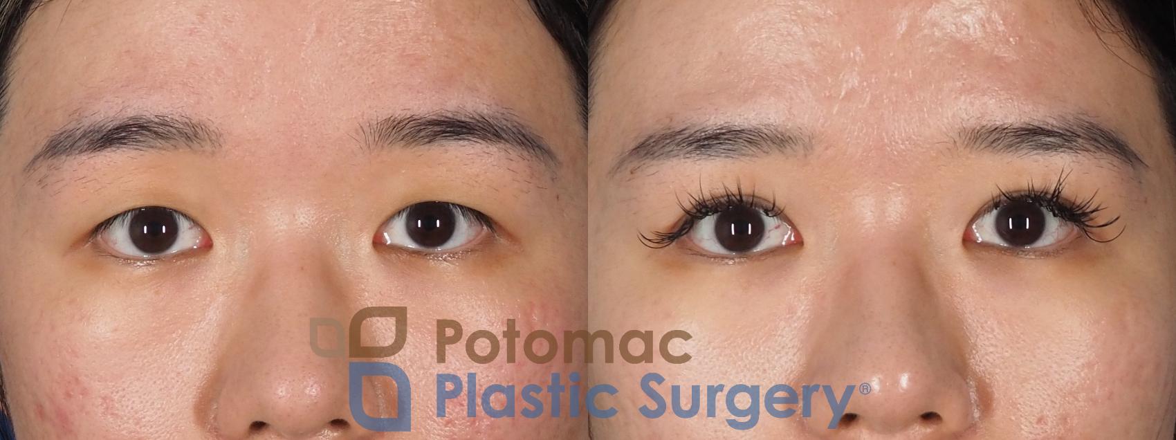 Before & After Blepharoplasty Case 323 Front View in Washington DC & Arlington , DC