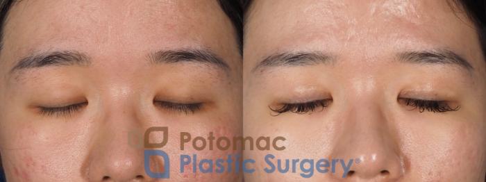 Before & After Asian Eyelid Surgery Case 323 Front - Eyes Closed View in Washington DC & Arlington , DC
