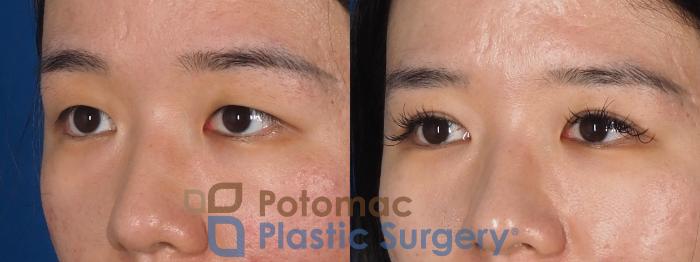 Before & After Asian Eyelid Surgery Case 323 Left Oblique View in Washington DC & Arlington , DC