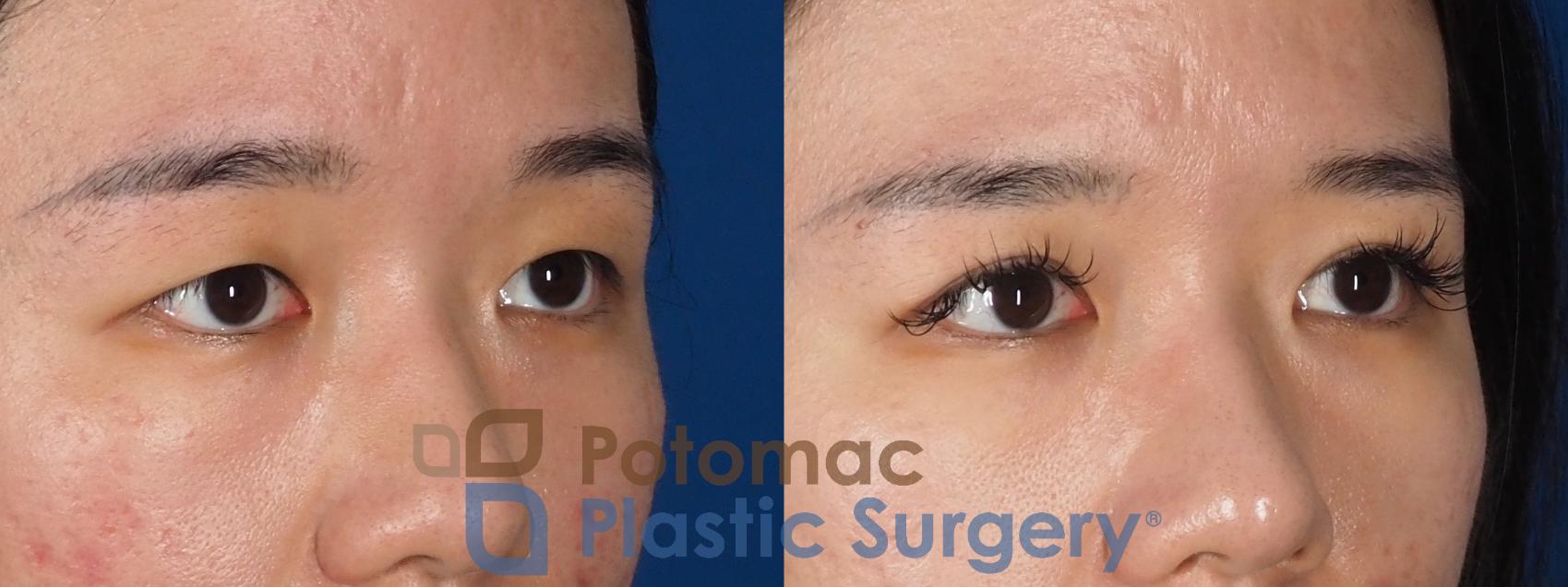 Before & After Blepharoplasty (Eyelid Surgery) Case 323 Right Oblique View in Washington DC & Arlington , DC