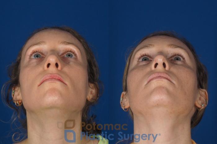 Before & After Facial Sculpting Case 326 Bottom View in Washington DC & Arlington , DC