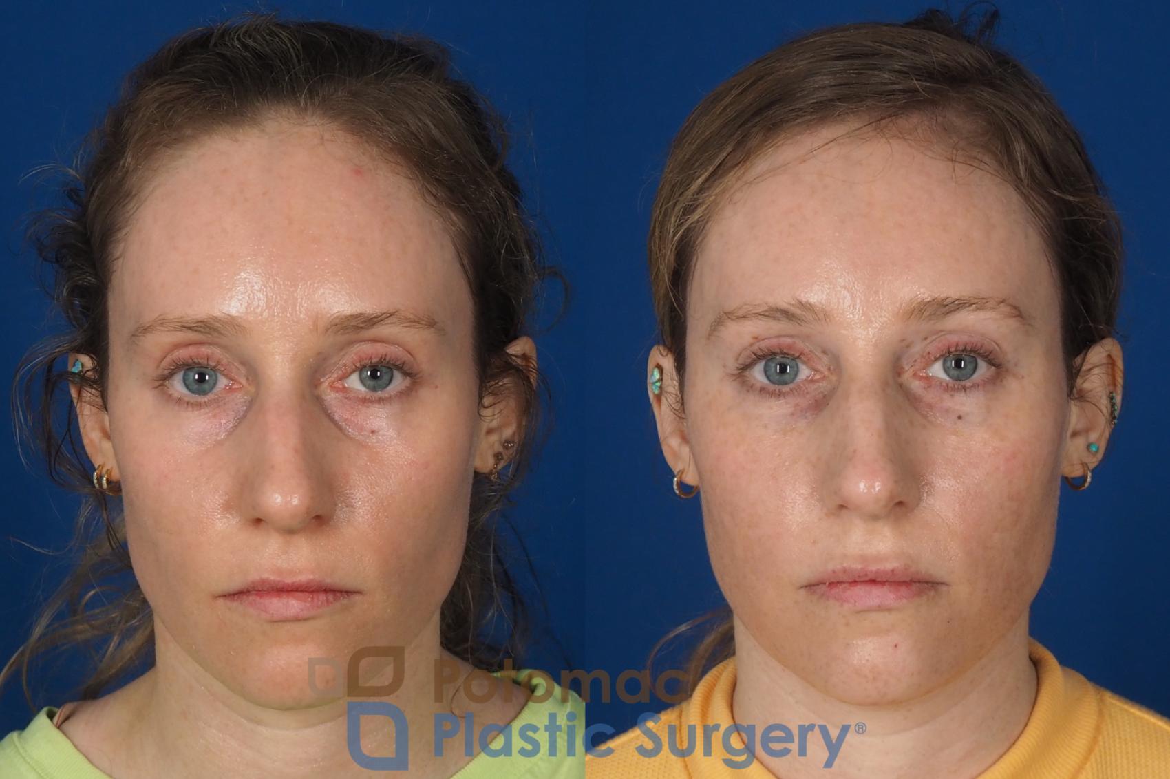 Before & After Blepharoplasty Case 326 Front View in Washington DC & Arlington , DC