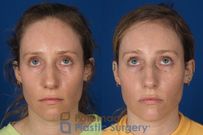 Before & After Blepharoplasty Case 326 Front - Looking Up View in Washington DC & Arlington , DC