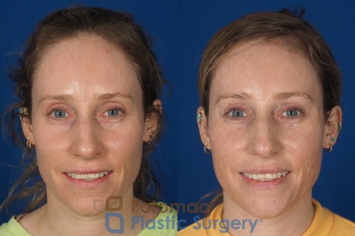 Before & After Facial Sculpting Case 326 Front - Smiling View in Washington DC & Arlington , DC