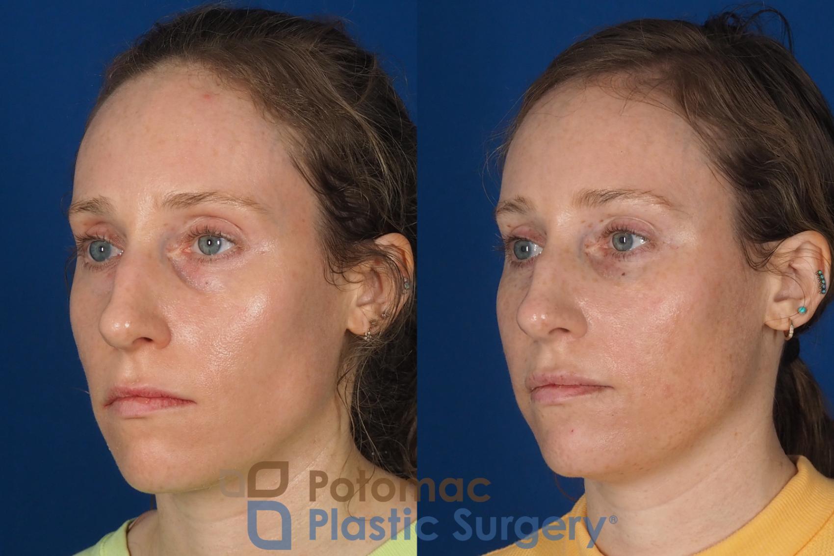 Before & After Fat Transfer Case 326 Left Oblique View in Washington DC & Arlington , DC