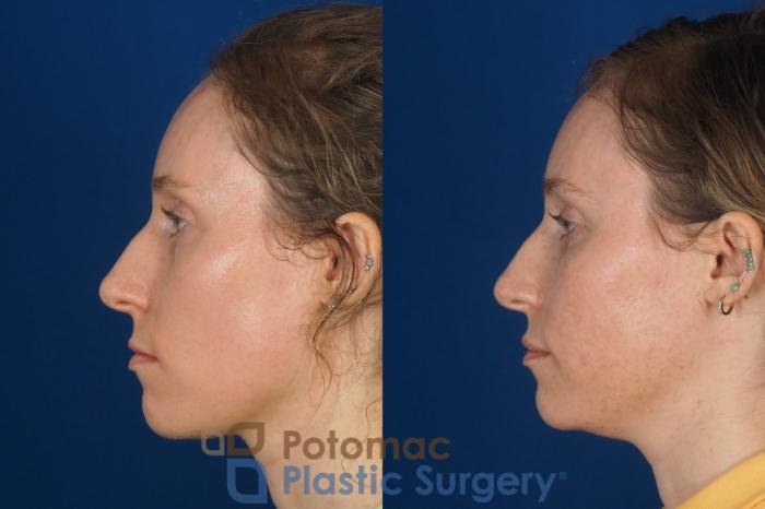 Before & After Blepharoplasty Case 326 Left Side View in Washington DC & Arlington , DC