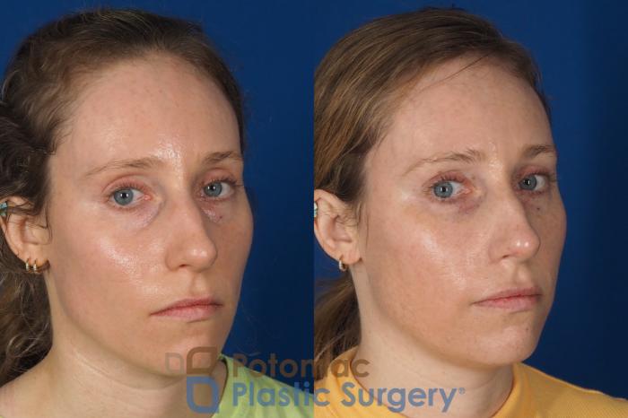 Before & After Blepharoplasty Case 326 Right Oblique 2 View in Washington DC & Arlington , DC
