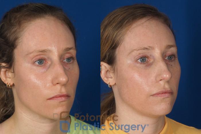 Before & After Blepharoplasty Case 326 Right Oblique View in Washington DC & Arlington , DC