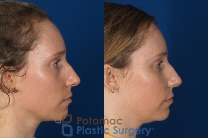 Before & After Blepharoplasty Case 326 Right Side View in Washington DC & Arlington , DC