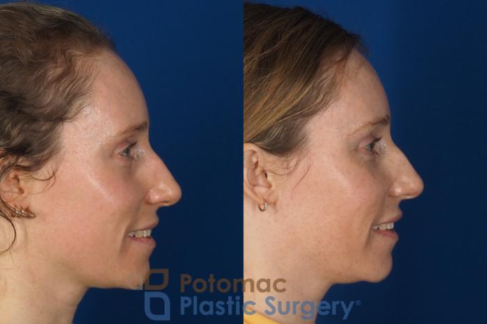 Before & After Blepharoplasty Case 326 Right - Smiling View in Washington DC & Arlington , DC