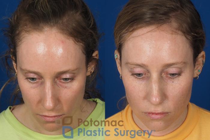 Before & After Blepharoplasty Case 326 Top View in Washington DC & Arlington , DC