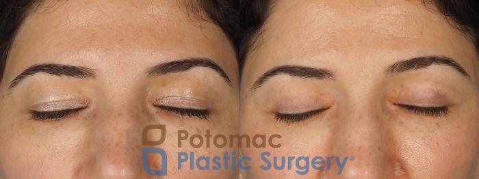 Before & After Blepharoplasty Case 328 Front - Eyes Closed View in Washington DC & Arlington , DC