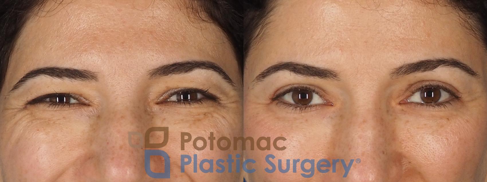 Before & After Blepharoplasty (Eyelid Surgery) Case 328 Front - Smiling View in Washington DC & Arlington , DC