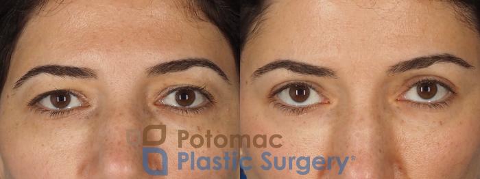 Before & After Brow Lift Case 328 Front View in Washington DC & Arlington , DC