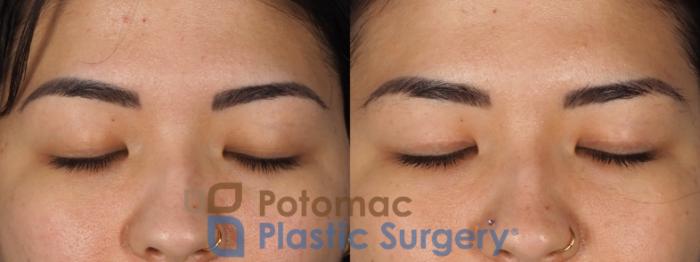 Before & After Asian Eyelid Surgery Case 333 Front - Eyes Closed View in Washington DC & Arlington , DC