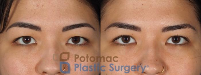 Before & After Blepharoplasty Case 333 Front View in Washington DC & Arlington , DC