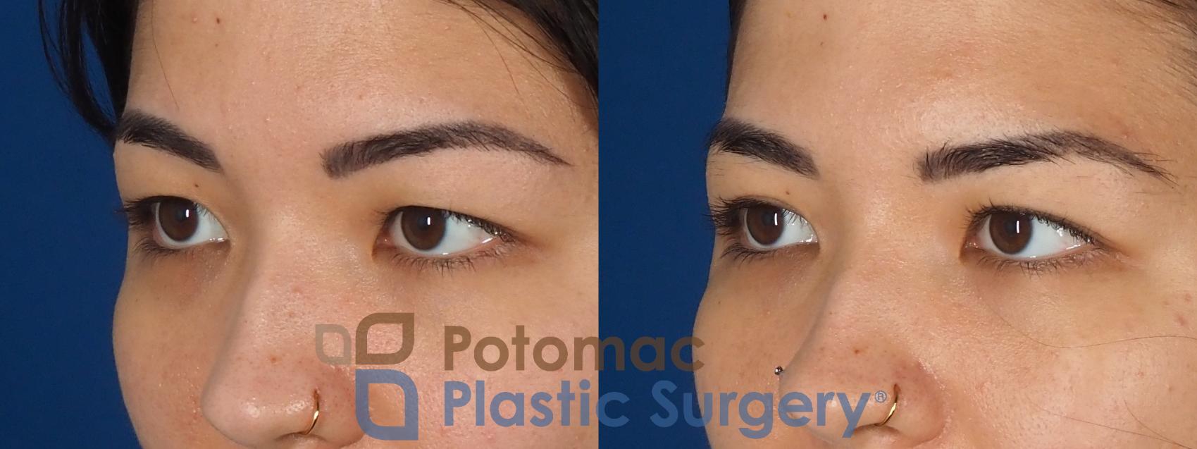 Before & After Blepharoplasty (Eyelid Surgery) Case 333 Left Oblique View in Washington DC & Arlington , DC