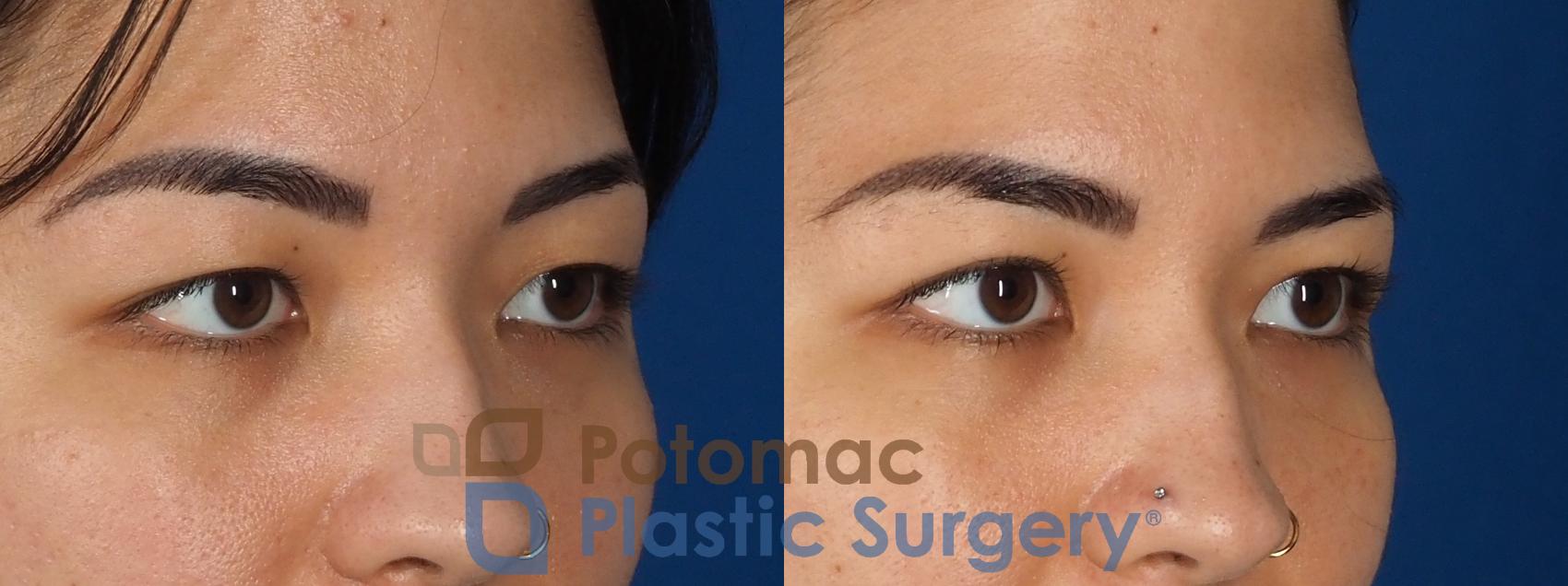 Before & After Blepharoplasty (Eyelid Surgery) Case 333 Right Oblique View in Washington DC & Arlington , DC