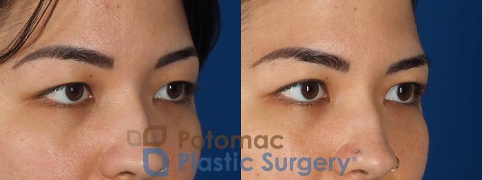 Before & After Blepharoplasty Case 333 Right Oblique View in Washington DC & Arlington , DC