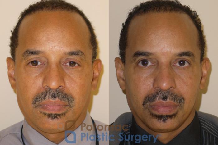 Before & After Blepharoplasty Case 48 Front View in Washington DC & Arlington , DC