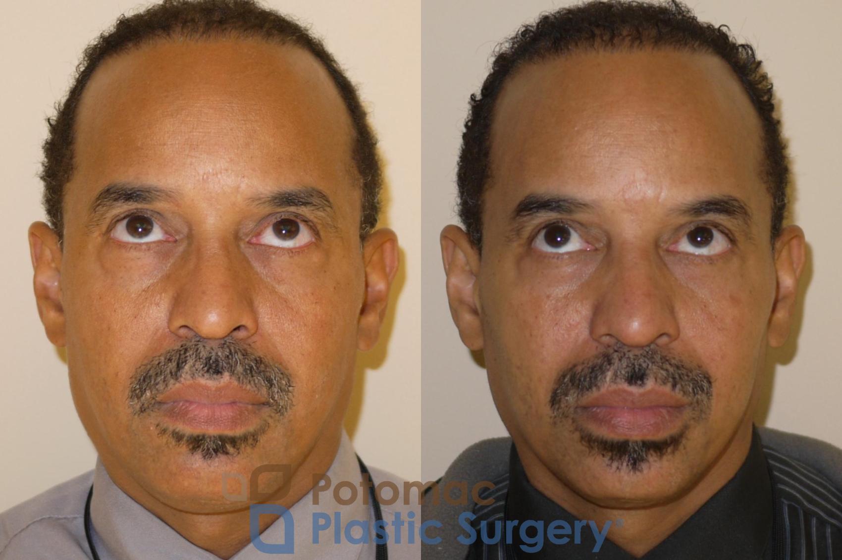 Before & After Blepharoplasty (Eyelid Surgery) Case 48 Front View #2 View in Washington DC & Arlington , DC