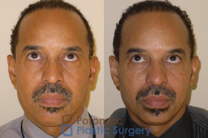 Before & After Blepharoplasty Case 48 Front View #2 View in Washington DC & Arlington , DC