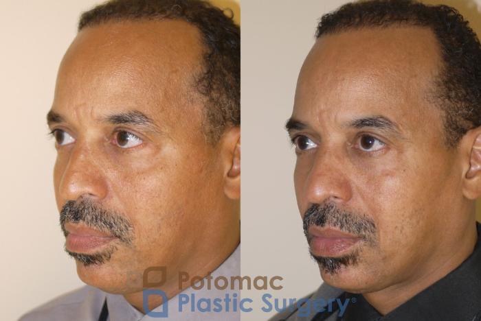 Before & After Blepharoplasty Case 48 Left Oblique View in Washington DC & Arlington , DC