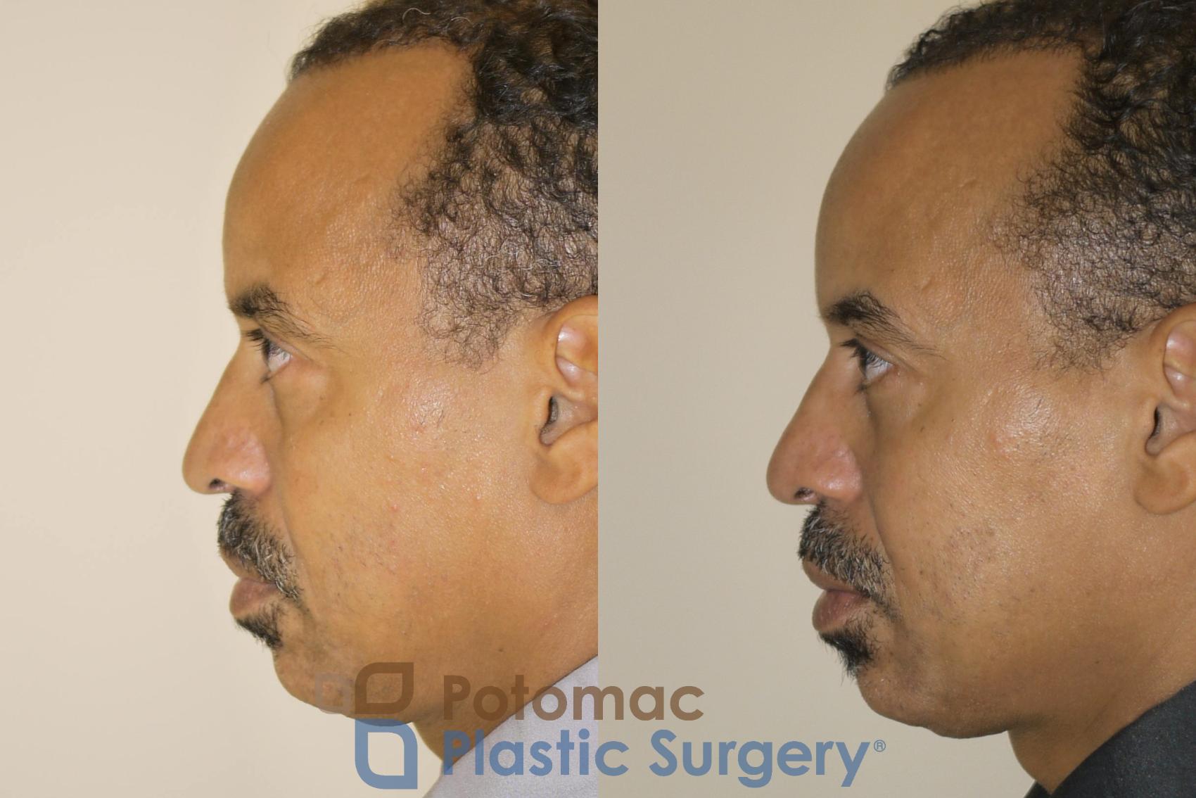Before & After Blepharoplasty (Eyelid Surgery) Case 48 Left Side View in Washington DC & Arlington , DC