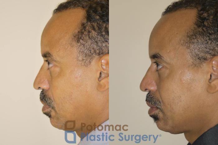 Before & After Blepharoplasty Case 48 Left Side View in Washington DC & Arlington , DC