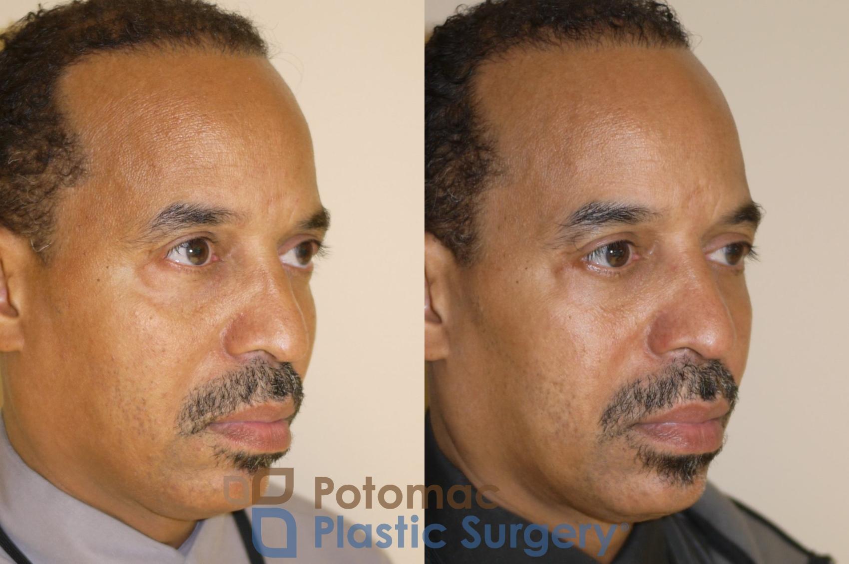 Before & After Blepharoplasty (Eyelid Surgery) Case 48 Right Oblique View in Washington DC & Arlington , DC