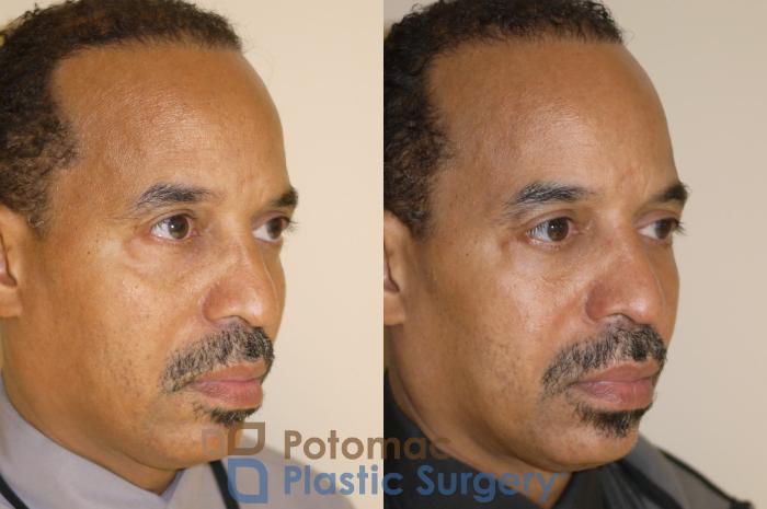 Before & After Blepharoplasty Case 48 Right Oblique View in Washington DC & Arlington , DC