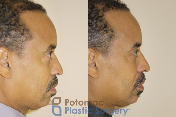 Before & After Blepharoplasty Case 48 Right Side View in Washington DC & Arlington , DC