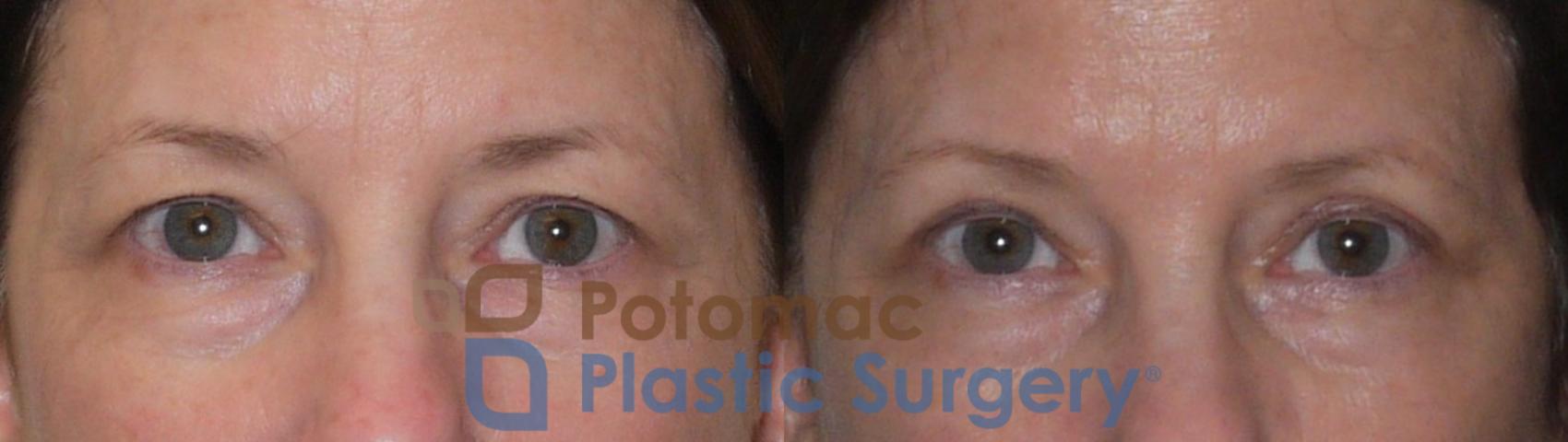 Before & After Blepharoplasty Case 97 Front View in Washington, DC