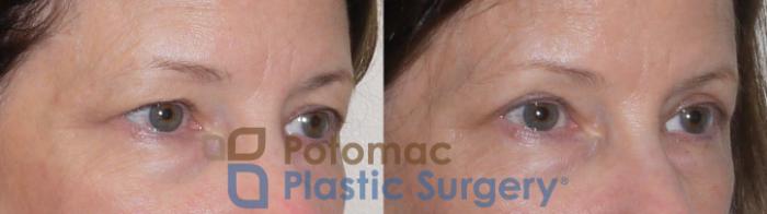 Before & After Blepharoplasty Case 97 Right Oblique View in Washington, DC