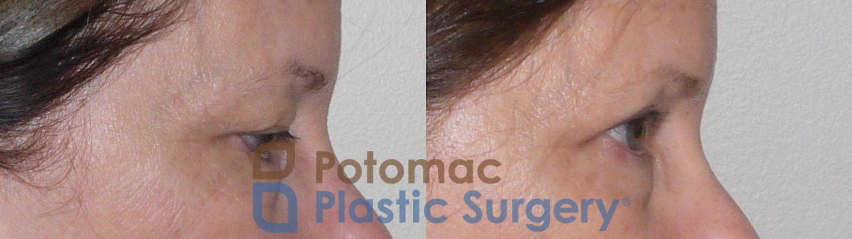 Before & After Blepharoplasty Case 97 Right Side View in Washington, DC