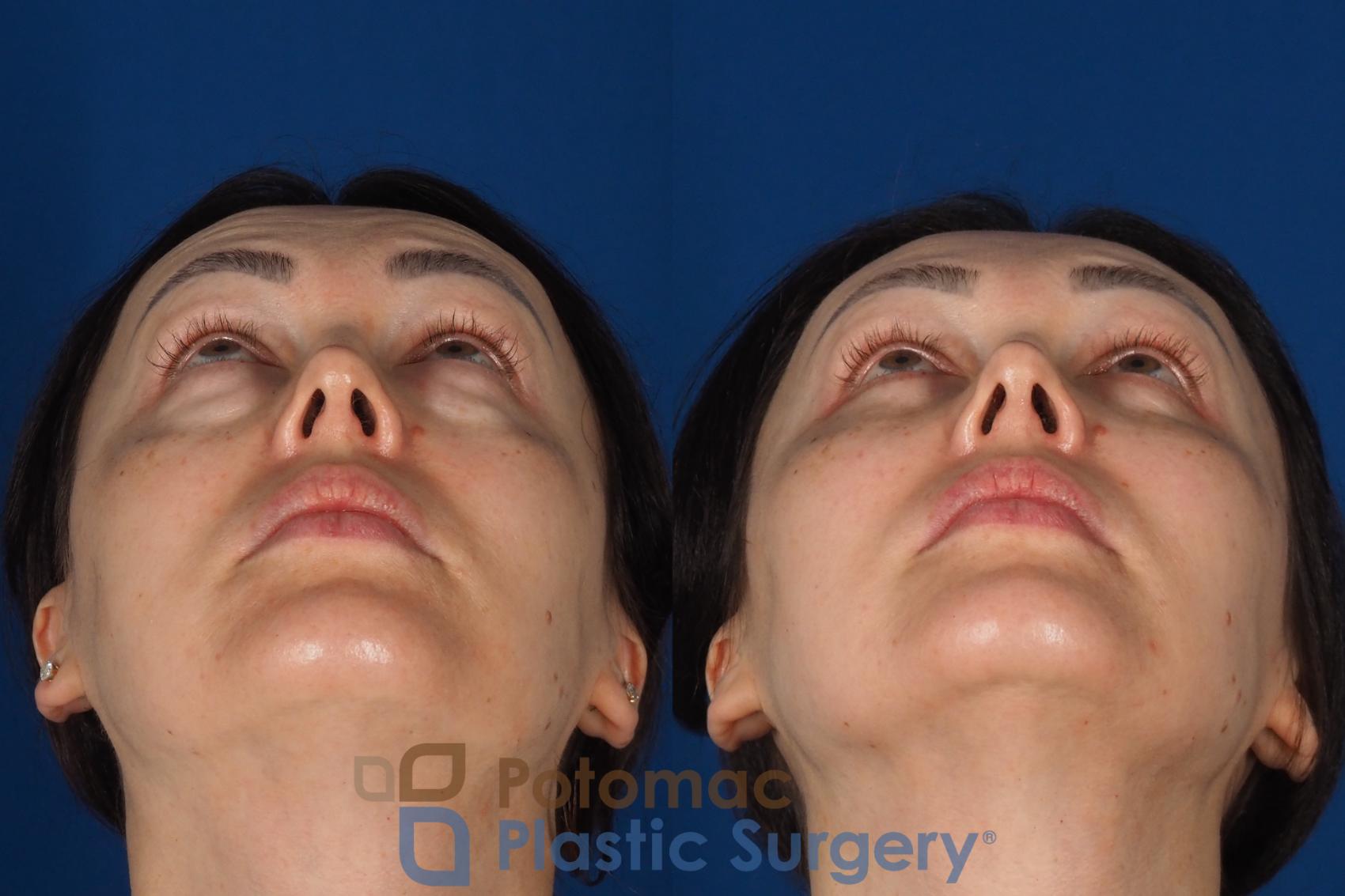 Before & After Fat Transfer Case 340 Bottom View in Washington DC & Arlington , DC