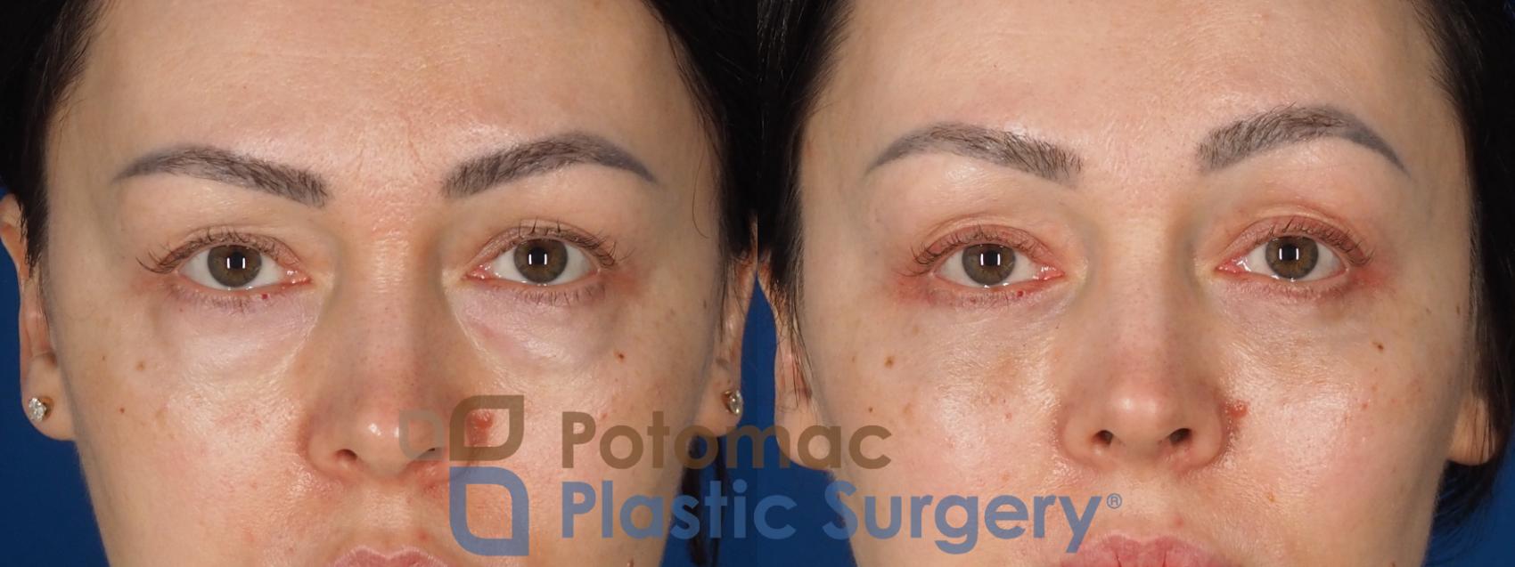 Before & After Fat Transfer Case 340 Front 2 View in Washington DC & Arlington , DC