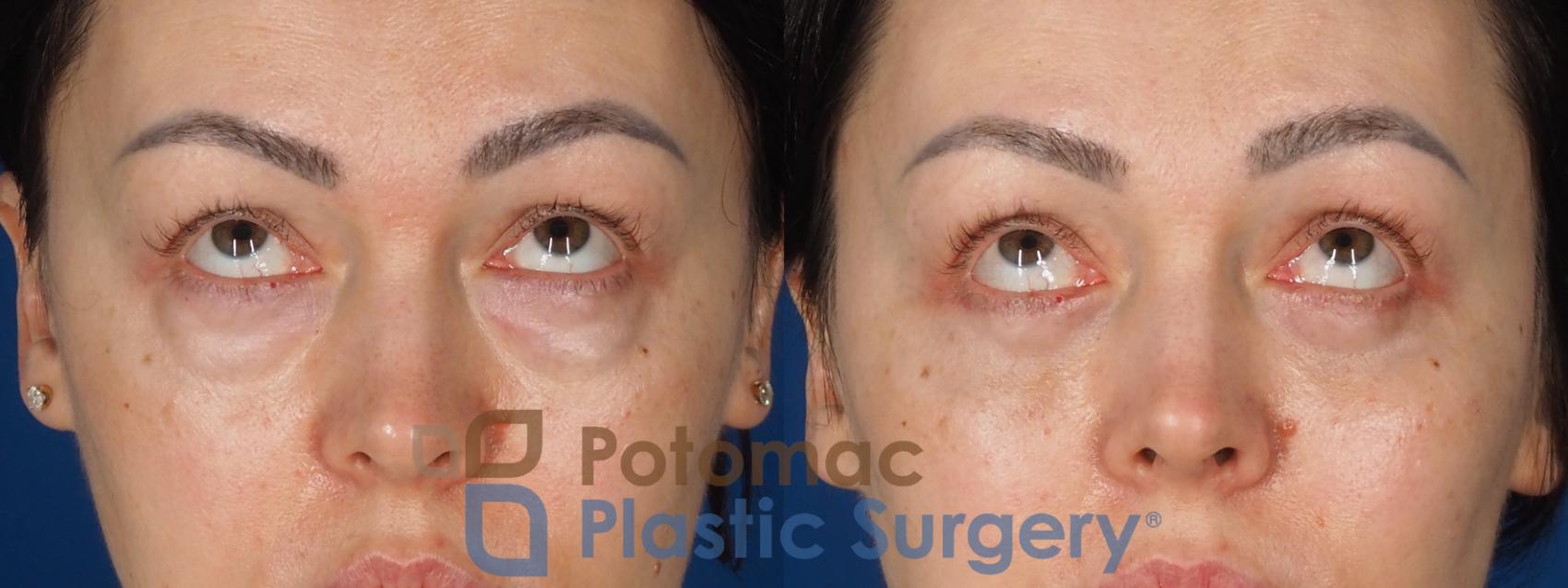 Before & After Fat Transfer Case 340 Front - Looking Up View in Washington DC & Arlington , DC