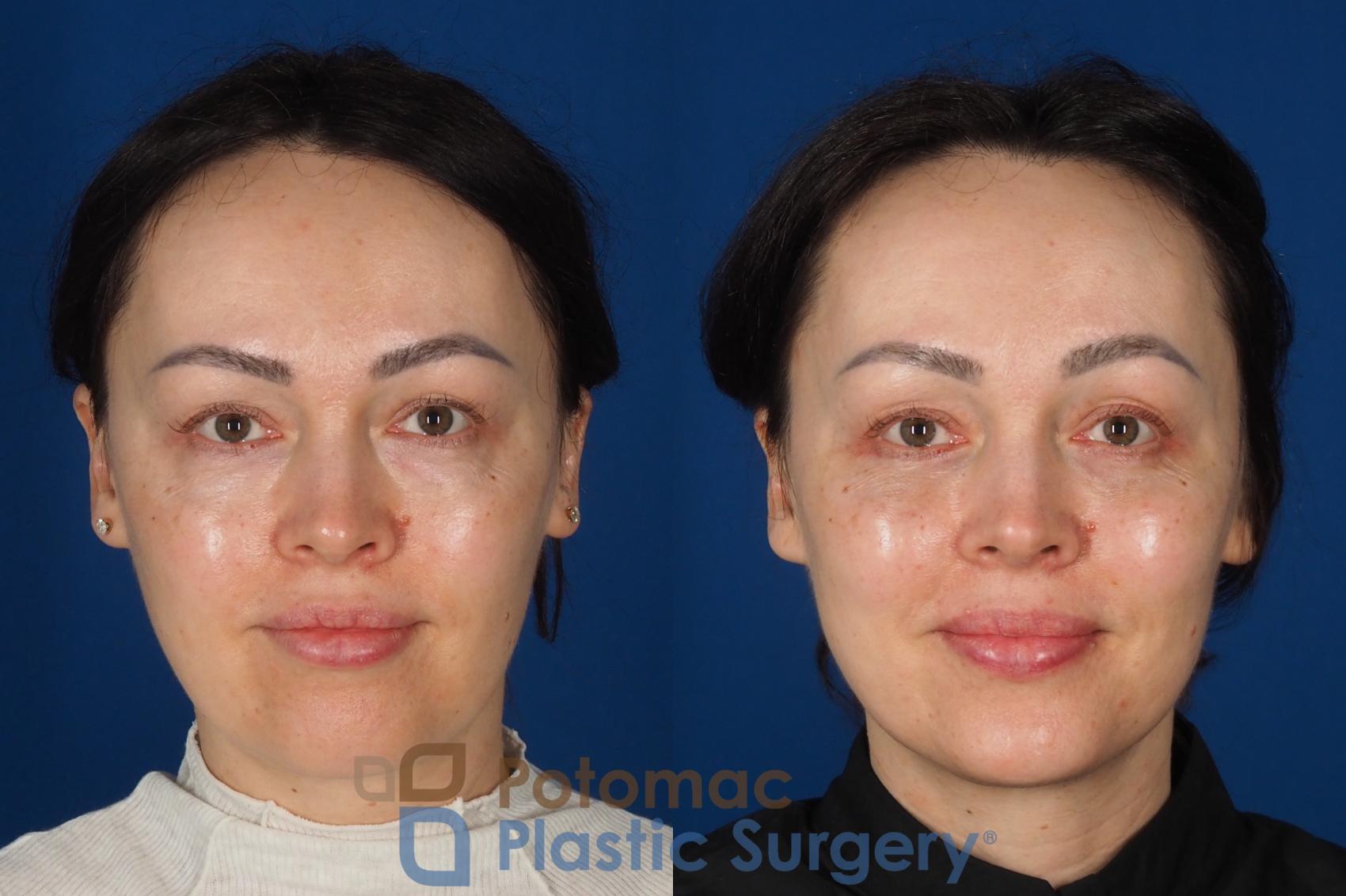 Before & After Fat Transfer Case 340 Front - Smiling View in Washington DC & Arlington , DC