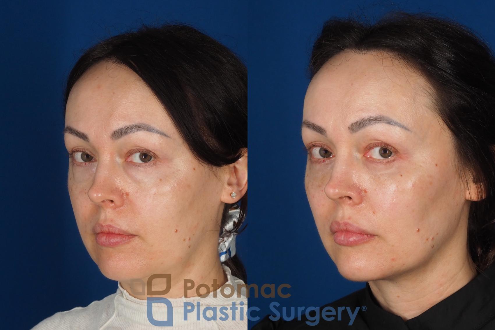 Before & After Fat Transfer Case 340 Left Oblique 2 View in Washington DC & Arlington , DC